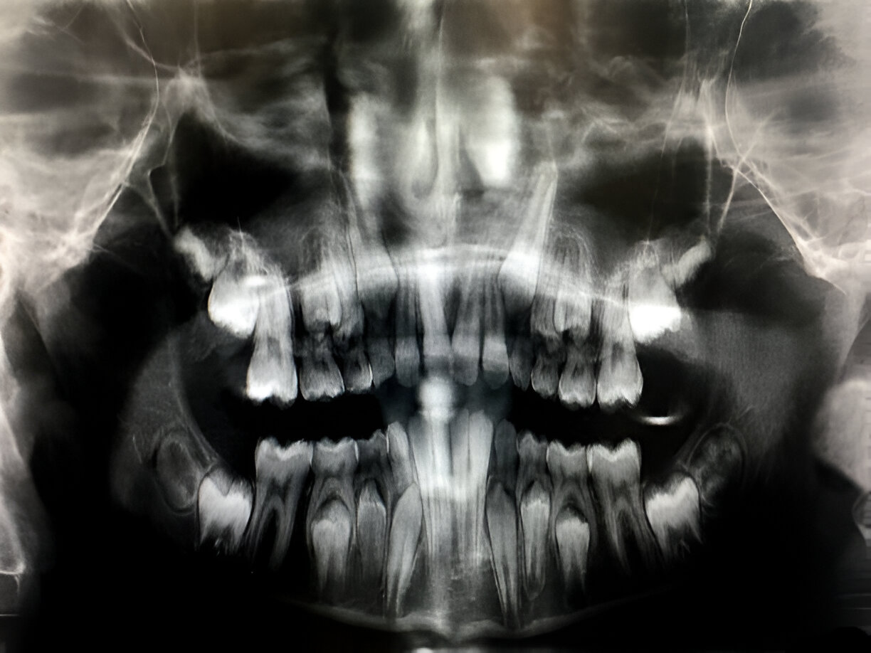 Cirugía de dientes Incluidos